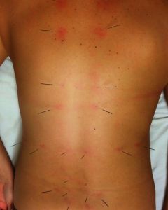 Island Acupuncture &amp; Massage photo